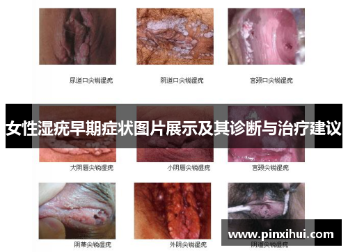 女性湿疣早期症状图片展示及其诊断与治疗建议
